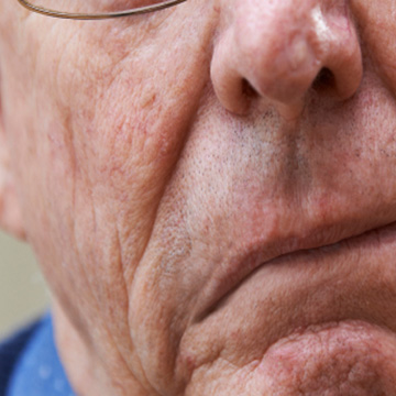 Stroke Rehabilitation